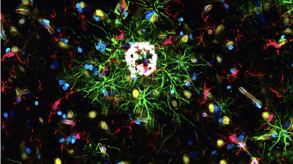 Repräsentatives Fluoreszenzbild eines Gewebsschnitts aus dem Gehirn eines an der Alzheimer-Krankheit erkrankten Körperspenders. Die verschiedenen Zellpopulationen des menschlichen Gehirns sind in unterschiedlichen Farben dargestellt, wobei Mikrogliazellen (rot) in unmittelbarer Nähe zu den für die Alzheimer-Krankheit typischen Proteinablagerungen (weiß) zu finden sind. Repräsentatives Fluoreszenzbild eines Gewebsschnitts aus dem Gehirn eines an der Alzheimer-Krankheit erkrankten Körperspenders. Die verschiedenen Zellpopulationen des menschlichen Gehirns sind in unterschiedlichen Farben dargestellt, wobei Mikrogliazellen (rot) in unmittelbarer Nähe zu den für die Alzheimer-Krankheit typischen Proteinablagerungen (weiß) zu finden sind.